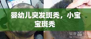 婴幼儿突发斑秃,小宝宝斑秃