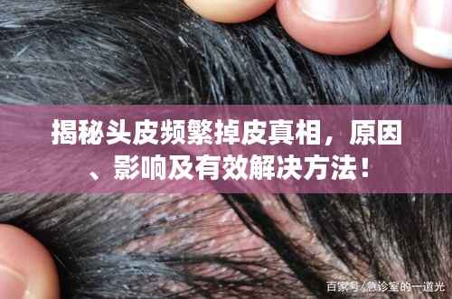 揭秘头皮频繁掉皮真相,原因、影响及有效解决方法!